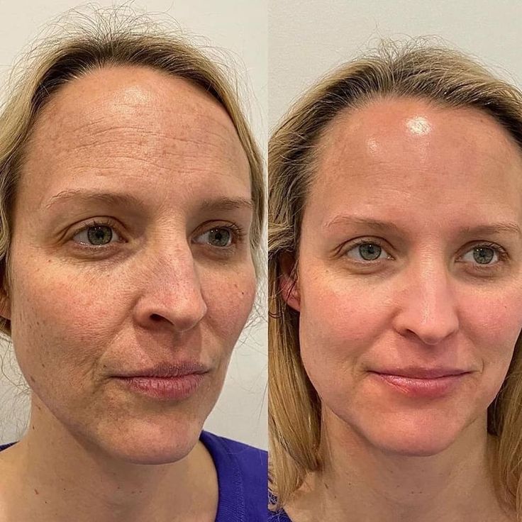 Rejuvenescimento Facial